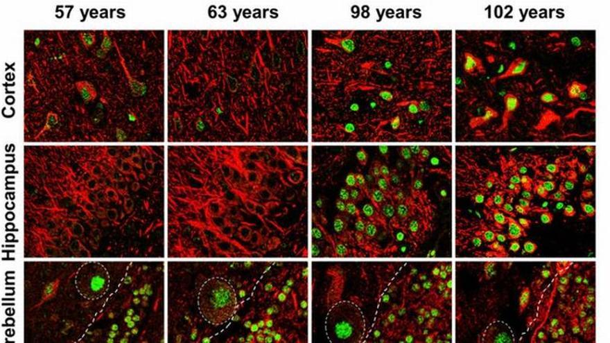 La resistencia del cerebro al estrés previene el alzhéimer