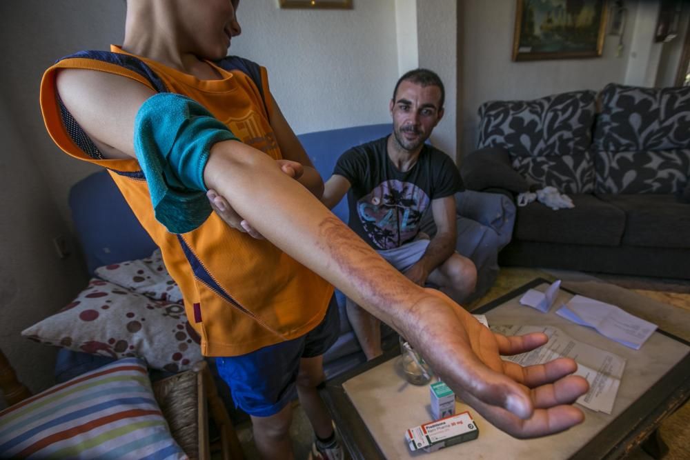 El niño que fue atendido por el contacto con la medusa portuguesa en la playa de La Marina lleva dos días sin ir al colegio por las molestias que todavía tiene en el brazo