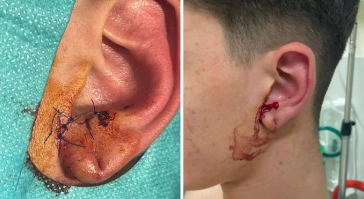 Las lesiones sufridas en la oreja por el menor víctima de la paliza grupal de A Laxe.