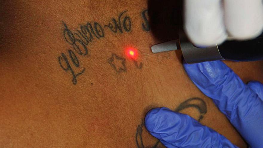 Eliminación de tatuaje en Clínicas Farma