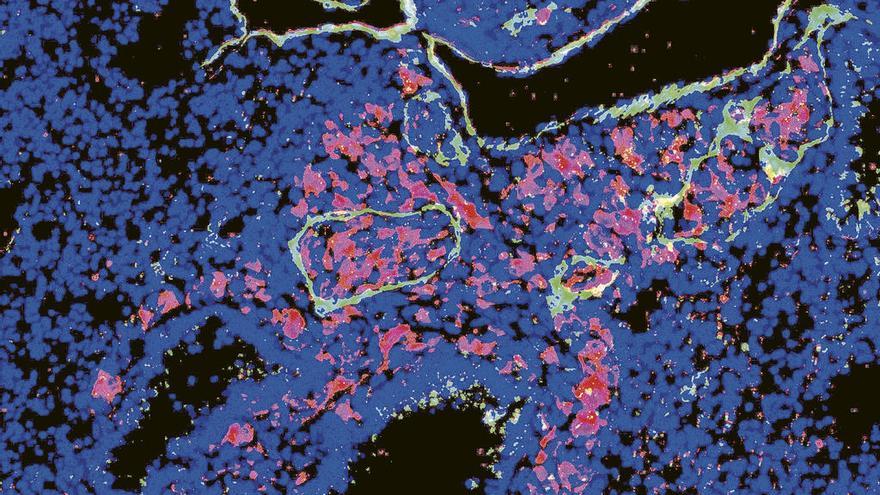 Científicos liderados por la gallega Soengas logran predecir la metástasis del melanoma