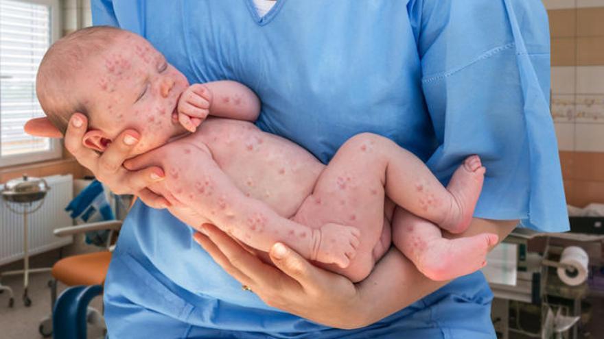 Un nadó afectat per xarampió.