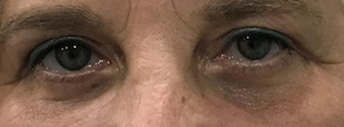 La misma paciente anterior, pero tras la blefaroplastia.
