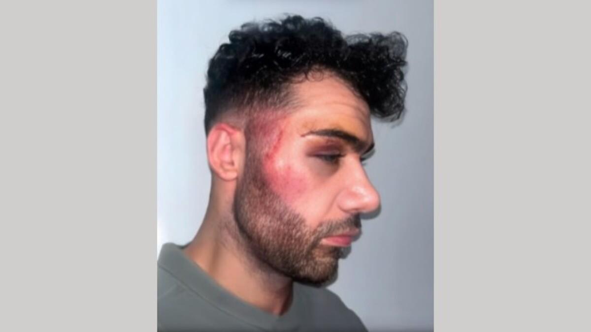 Secuelas de la brutal paliza recibida por Óscar, camarero del pub Bloom de Santiago