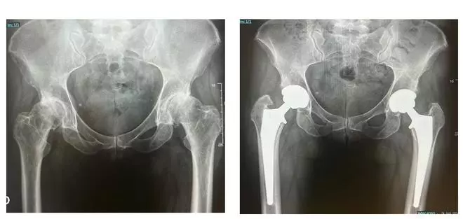 Vithas Valencia Turia, primer hospital privado de la provincia en completar con éxito la cirugía bilateral de cadera simultánea por vía anterior