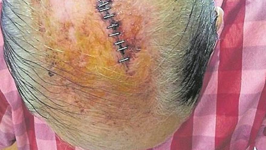 Herido un vila-realense al caerle un cartel publicitario en la cabeza