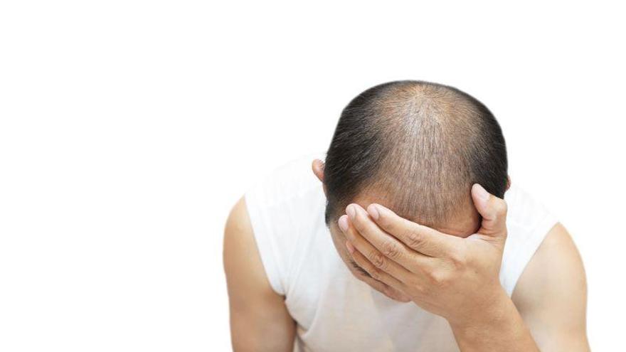 Dos soluciones idóneas y económicas para aquellos que sufren alopecia