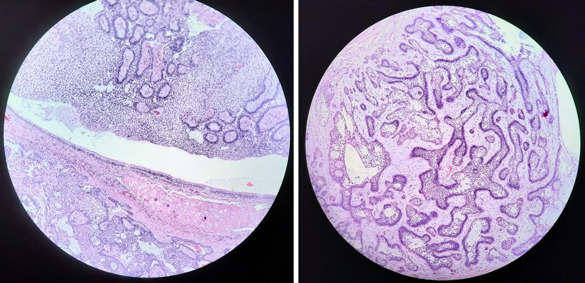 Ameloblastoma Intrabronchial