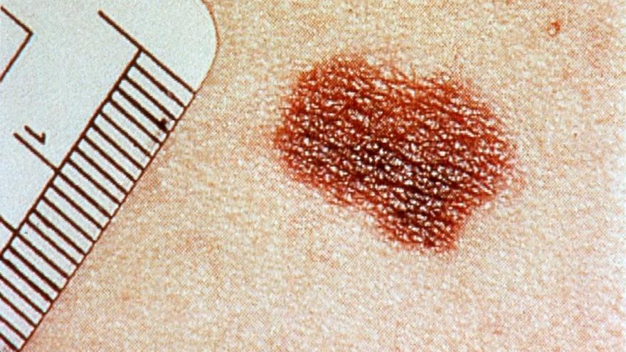 Imagen de un melanoma en la piel. Fotografiar la espalda desnuda de su pareja puede ser un modo divertido de controlar que esos lunares que la adornan sean sólo graciosos y no señal de un melanoma , un cáncer de piel que, detectado tarde, podría acabar con su vida. EFE/Archivo