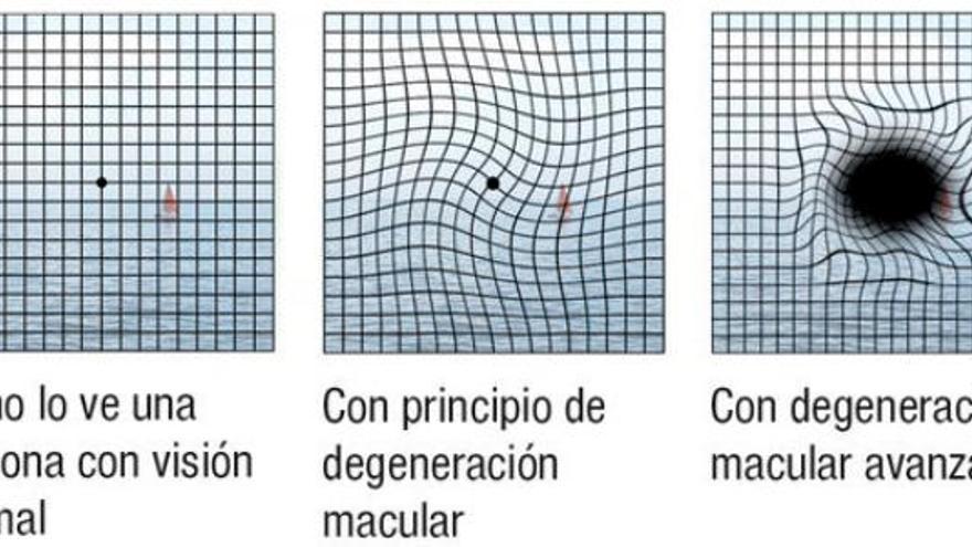 Reixeta d&#039;Amsler. A l&#039;esquerra, quadrícula que es percep amb visió normal. Al mig, amb principi de DMAE. A la dreta, amb DMAE avançada