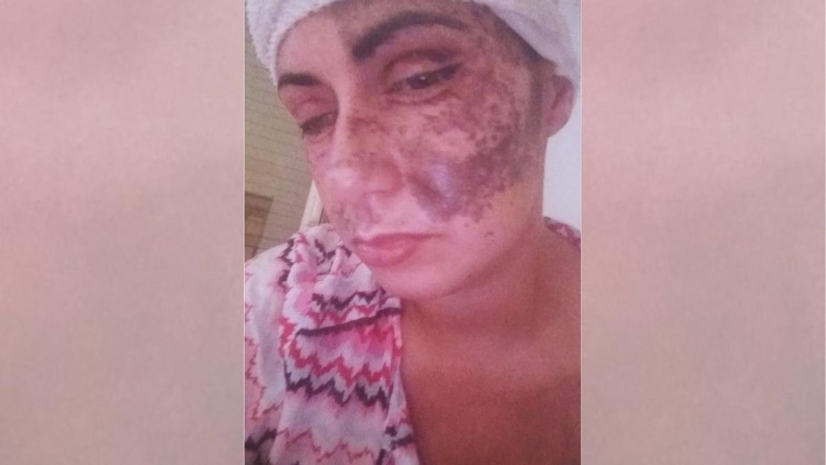 Víctima de un brutal ataque con sosa cáustica: pierde un ojo y queda arruinada tras luchar por su tratamiento
