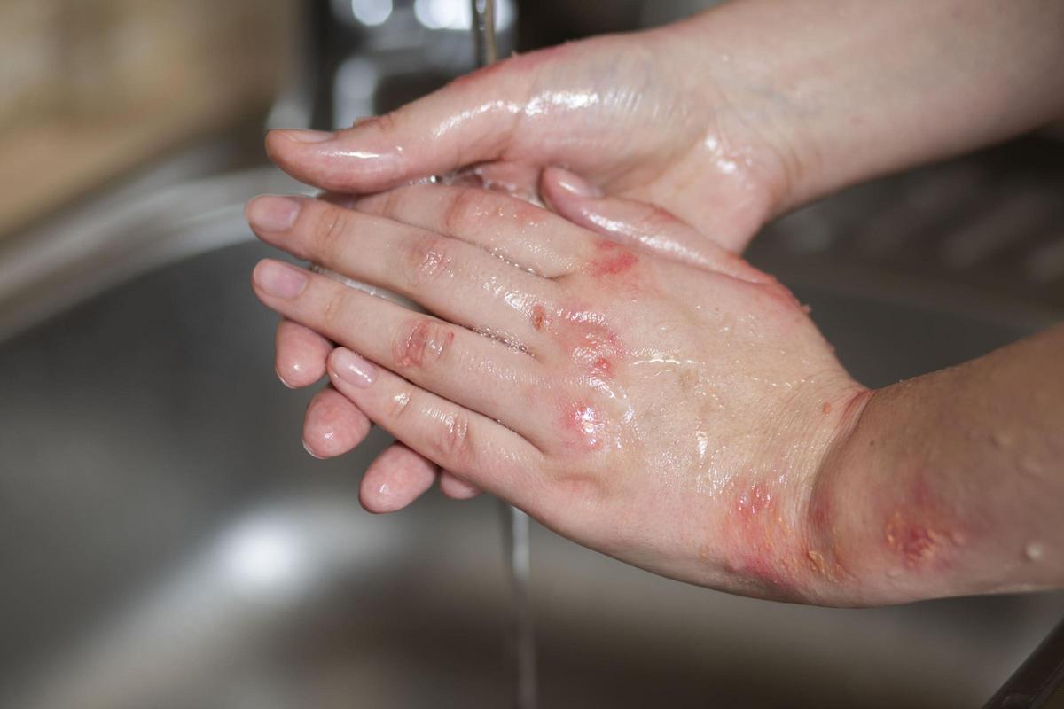 Renta't la cremada amb aigua i sabó