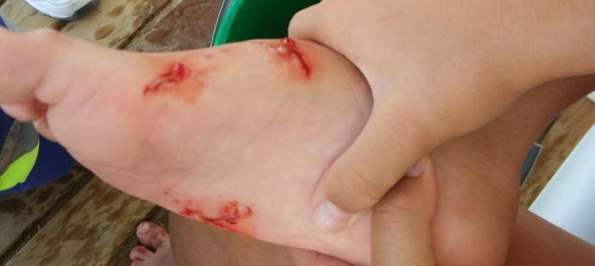 Un pez muerde a una bañista y le secciona un tendón del pie en la playa del Rebollo de Elche