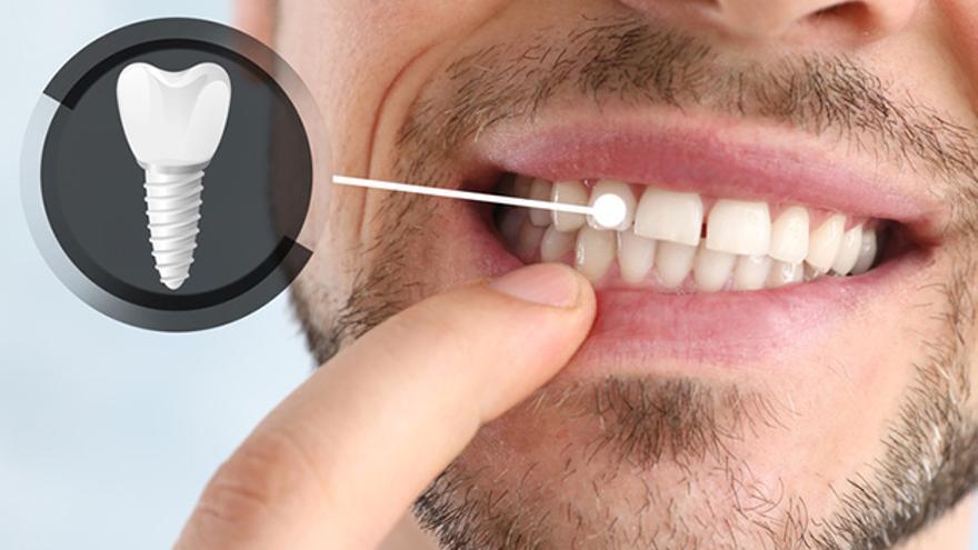Tus implantes dentales en Clínica Dental DUELINE por solo 750€