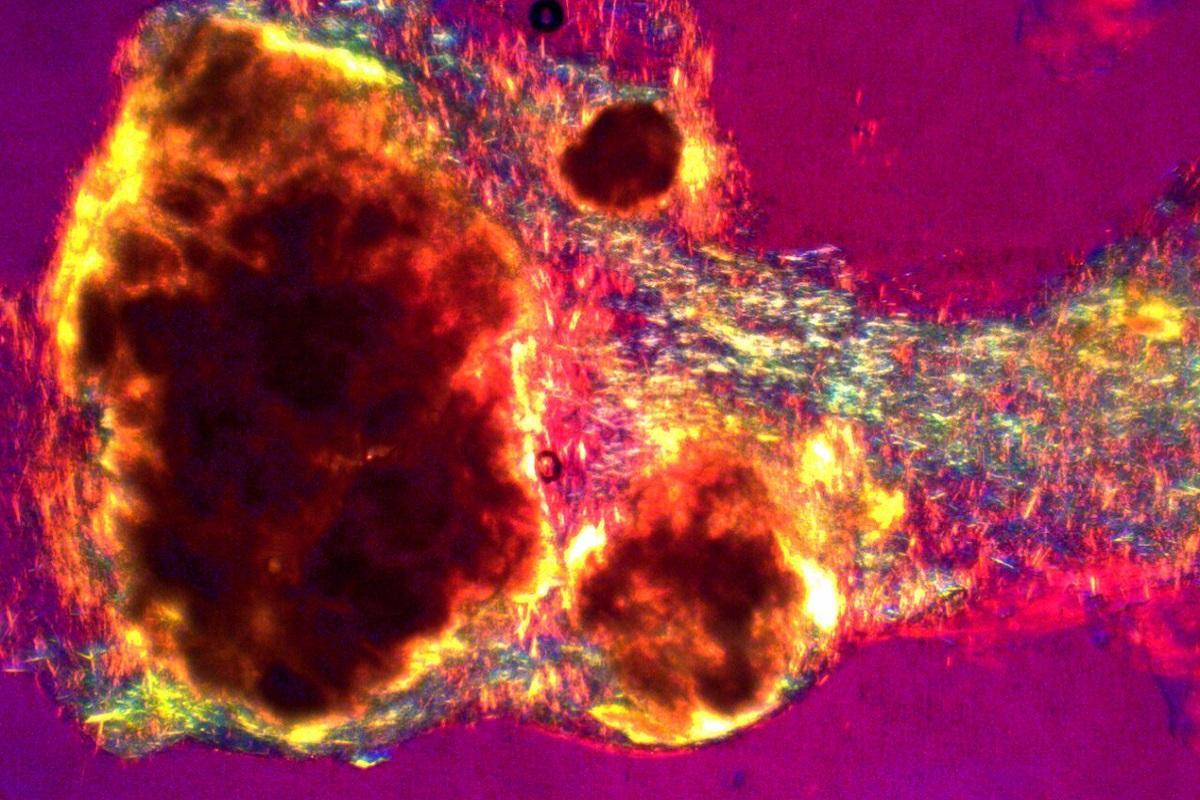 Esta es la enfermedad que aumenta debido a los excesos del verano.