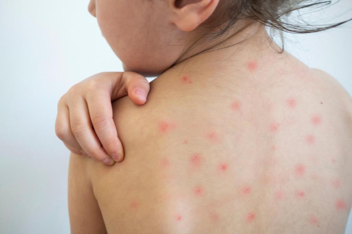 ¿Cómo se contagia y cuáles son los síntomas de la varicela?