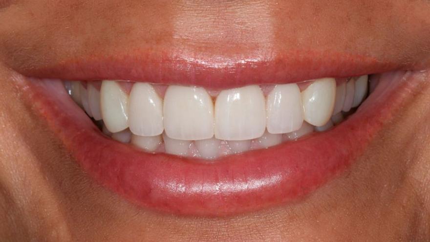 Las carillas de porcelana son unas delgadas láminas de cerámica o porcelana, que se adhieren a la parte frontal de los dientes para mejorar su apariencia