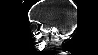 Cirujanos de Sant Joan de Déu extraen una aguja de dentista del cerebro de una niña