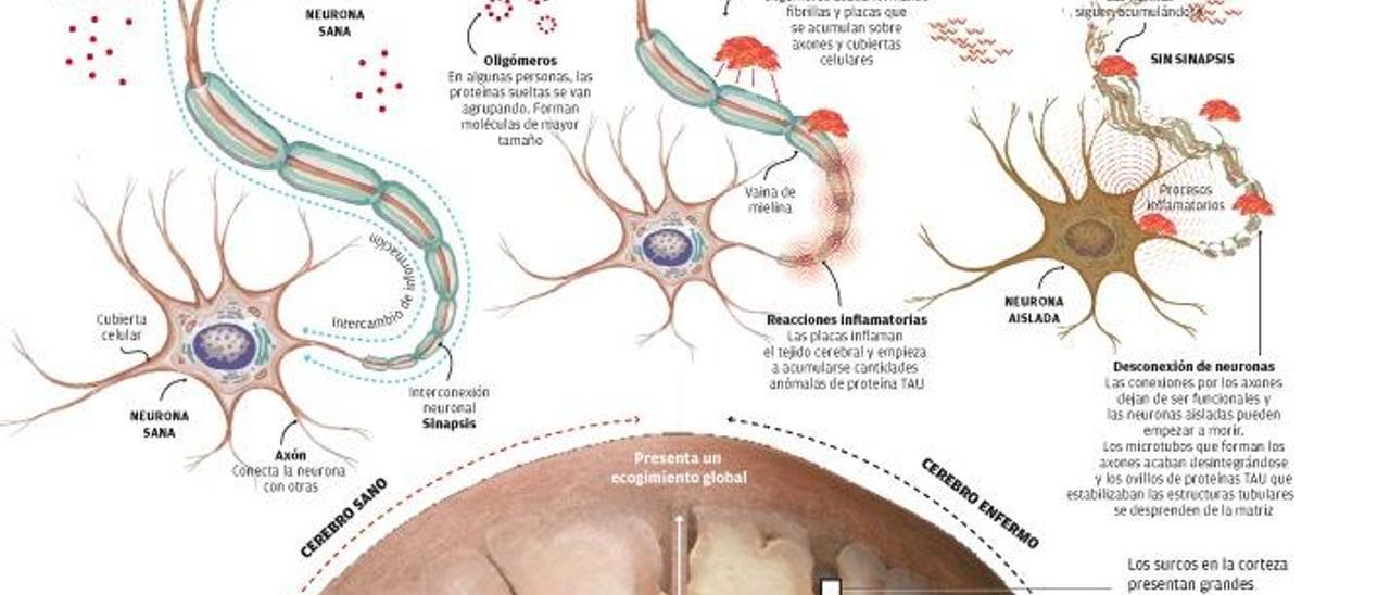 Una terapia para deshacer los &#039;depósitos&#039; del alzhéimer