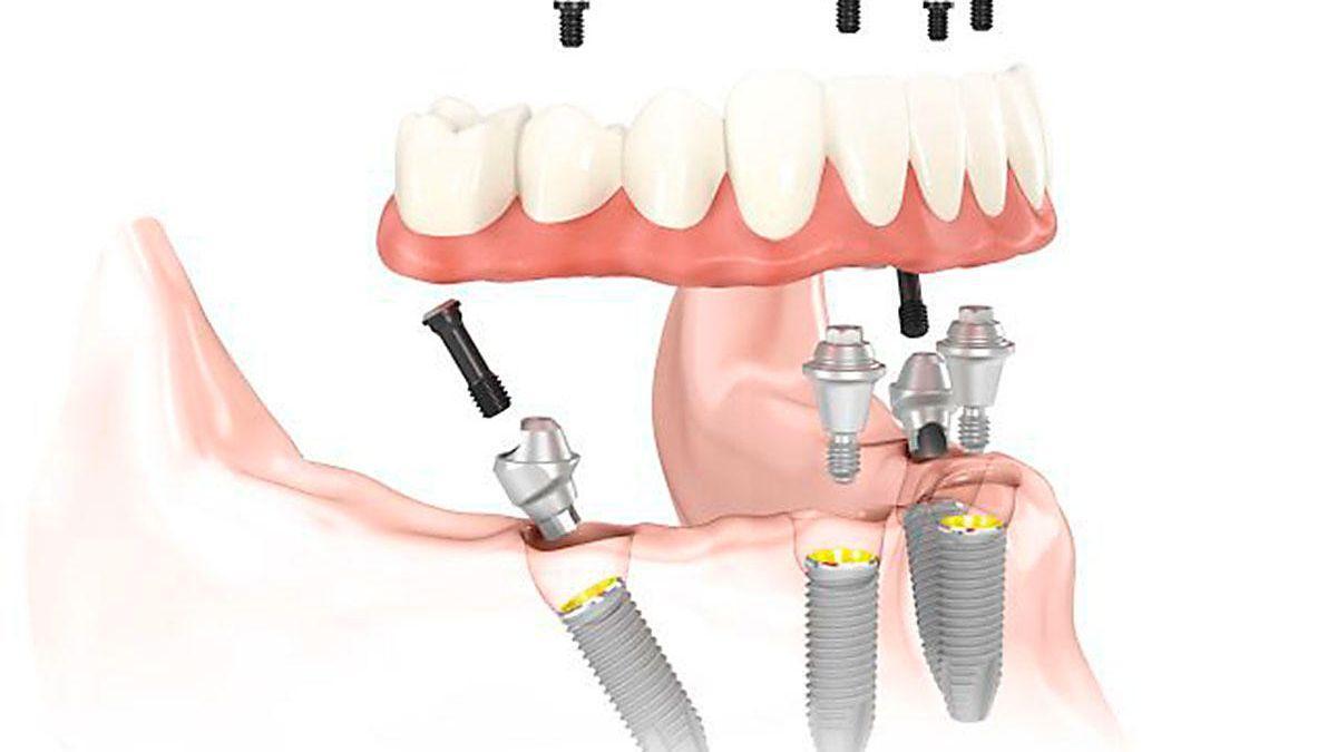 “All-on-4” es una técnica que permite al paciente hacer una vida prácticamente normal desde el mismo día de la intervención.