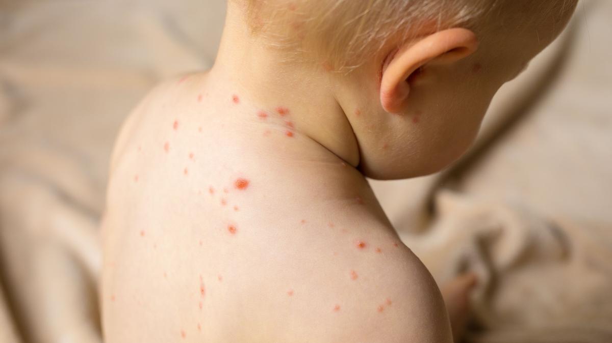 Baby with chicken pox   Bebé con varicela   foto recurso para el virus del tomate