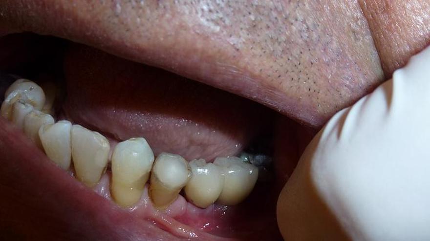 Quines són les causes de les dents tortes?
