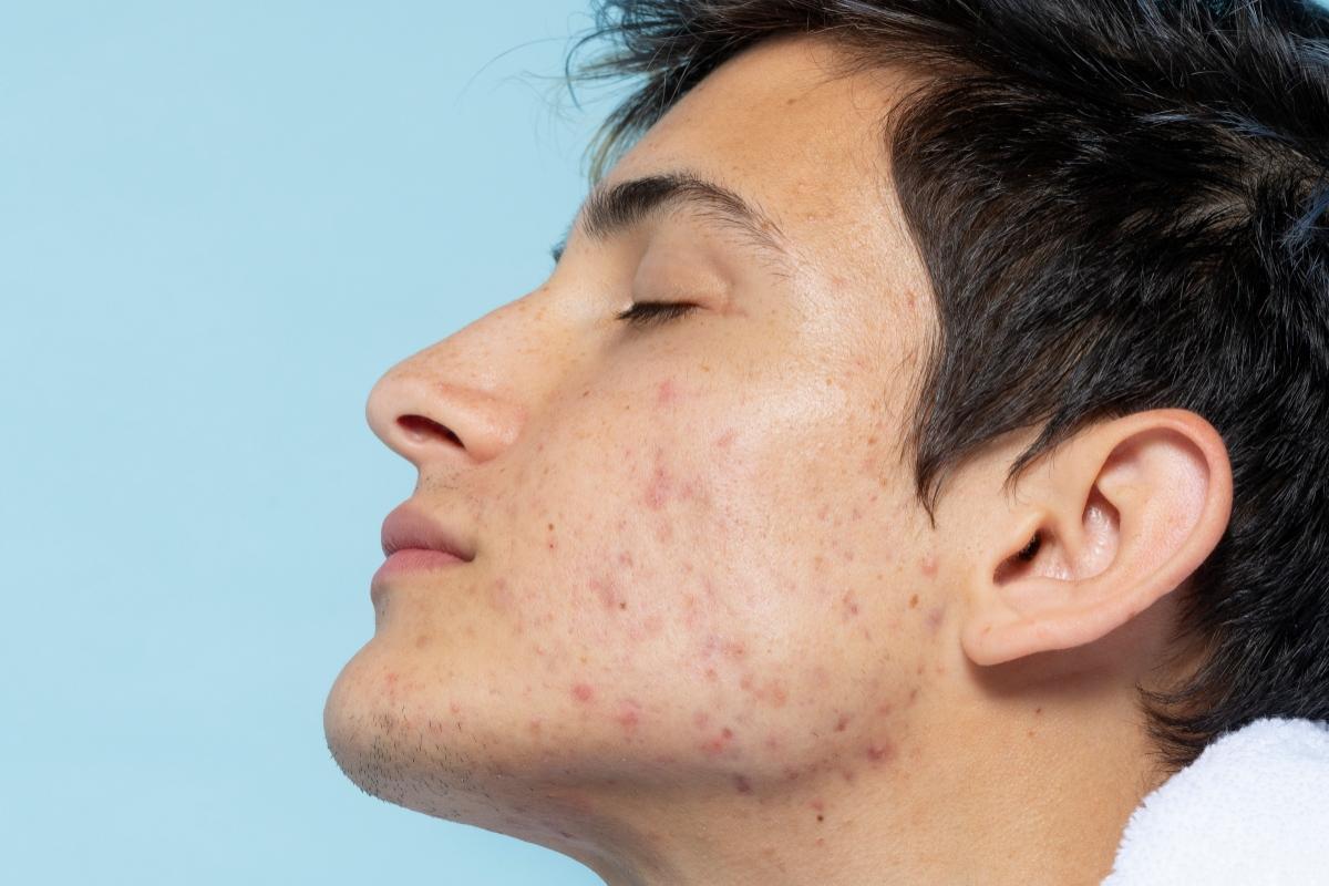 El limpiador de CeraVe para acabar de una vez por todas con el acné