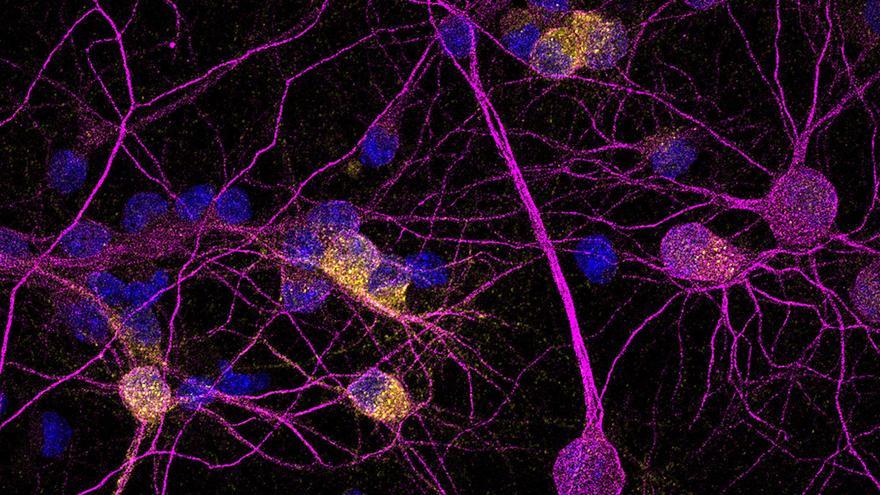 Identifican una proteína clave para la supervivencia de las neuronas en la devastadora enfermedad de Huntington