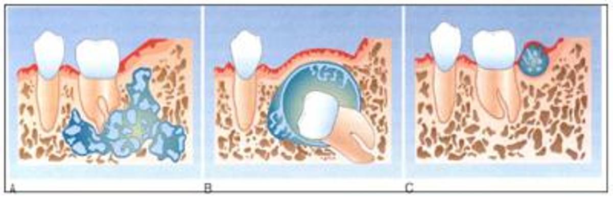 Imagen de un Ameloblastoma