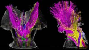Tractos multicolores emanan de núcleos extrareticulares adicionales del tronco del encéfalo, que ahora se cree que contribuyen a la vigilia en el cerebro humano.