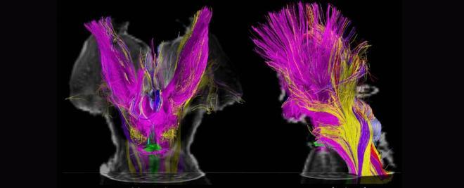 Tractos multicolores emanan de núcleos extrareticulares adicionales del tronco del encéfalo, que ahora se cree que contribuyen a la vigilia en el cerebro humano.