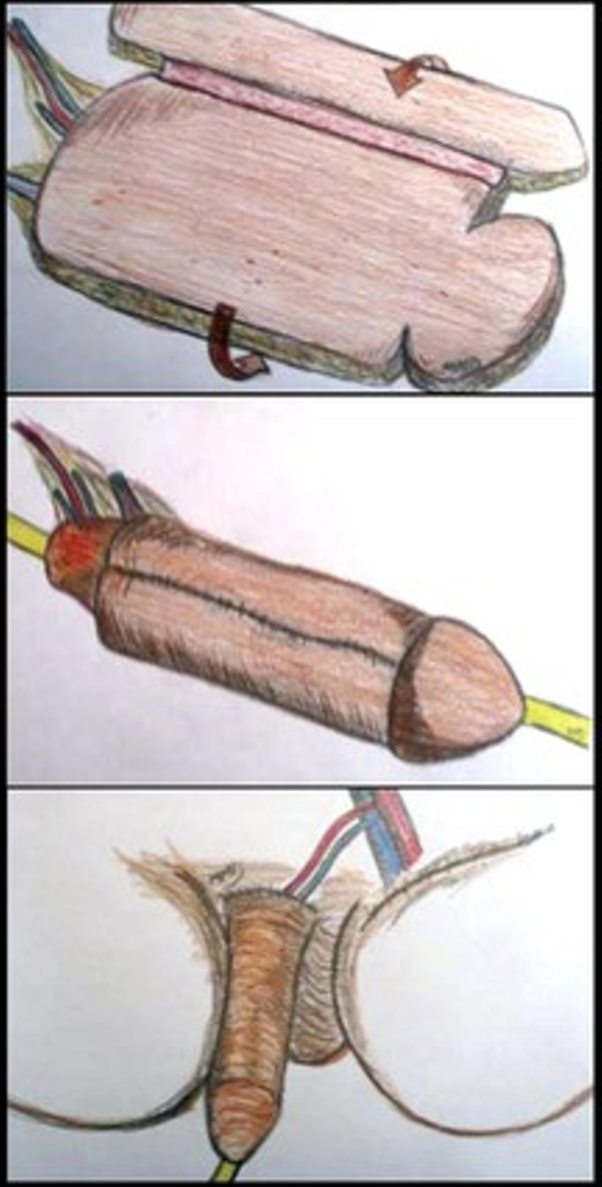 Il·lustració que mostra una reconstrucció completa de penis amb implant de pròtesi. Il·lustració que mostra una reconstrucció completa de penis amb implant de pròtesi.
