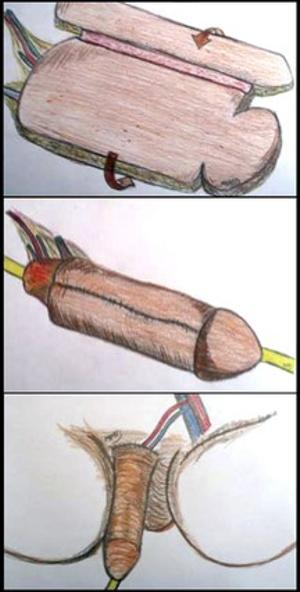 Il·lustració que mostra una reconstrucció completa de penis amb implant de pròtesi.