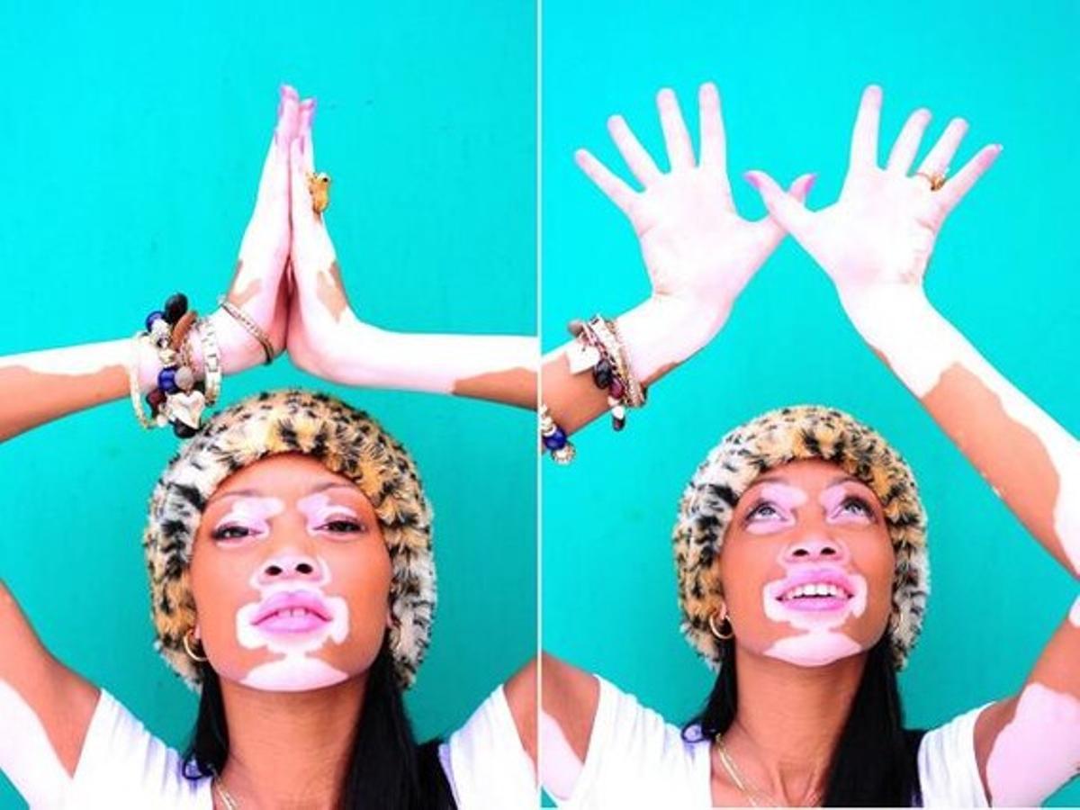 Winnie Harlow.