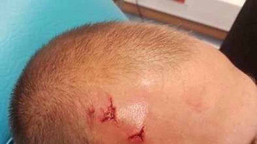 Imagen de las heridas en la cabeza dell delantero Bas Dost.