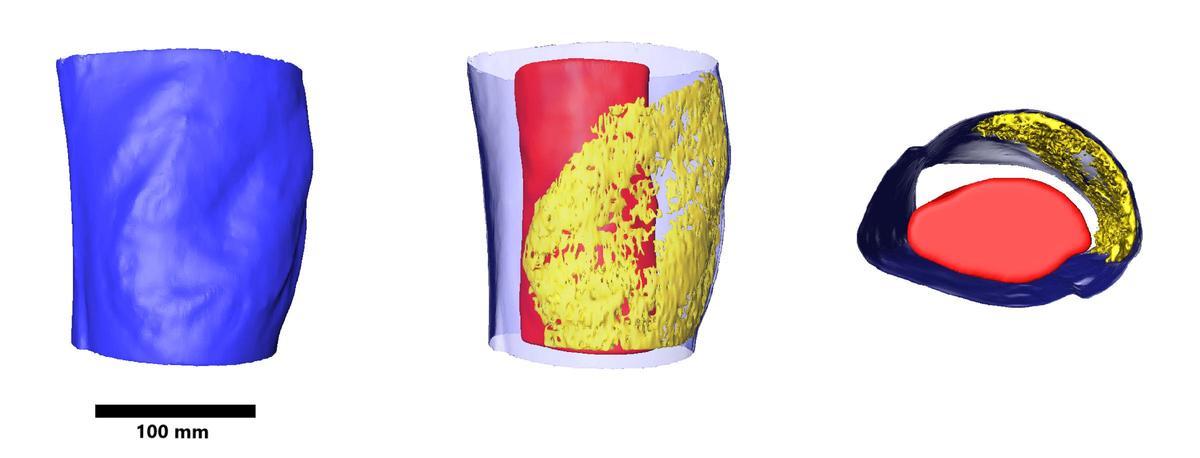 Figura 1: Tibia con detalle de la lesión ósea. Reconstrucción tridimensional obtenida mediante tomografía computarizada mostrando la estructura interna de la lesión. Figura 2: Modelos tridimensionales que ilustran la distribución del tejido óseo patológico generado como respuesta a la infección.