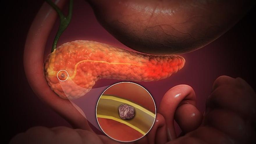 Pancreatitis aguda: ¿por qué es importante controlar sus síntomas antes de las 72 horas?