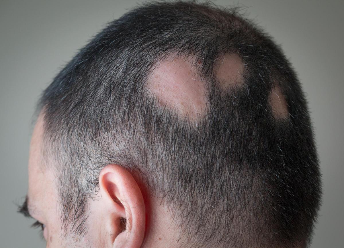 Un caso de alopecia areata