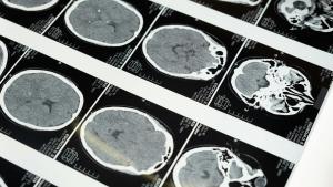 Linfoma cerebral, la enfermedad que padece Raphael y que representa el 4% de los tumores intracraneales