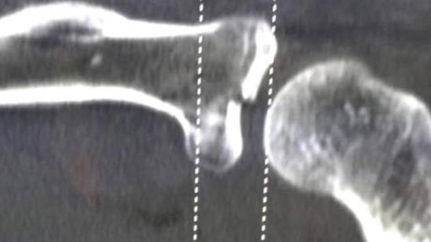Radiografía de la lesión. // FdV