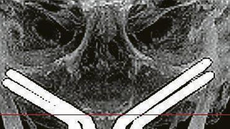 Radiografía de unos implantes cigomáticos. | clínica rehberger