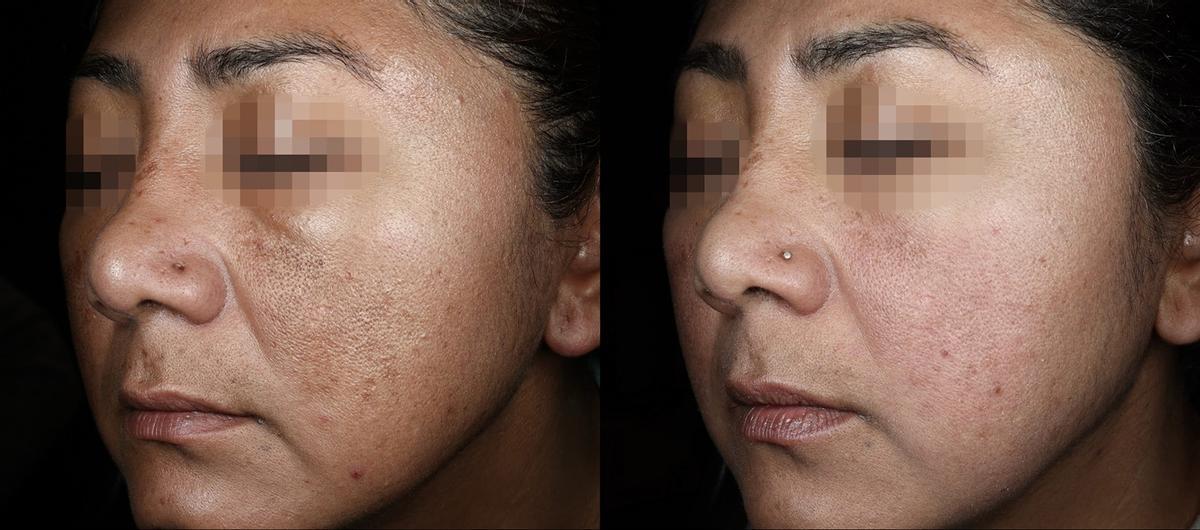 La herramienta destaca por su capacidad de tratar en un mismo enfoque rostro, cuello y escote