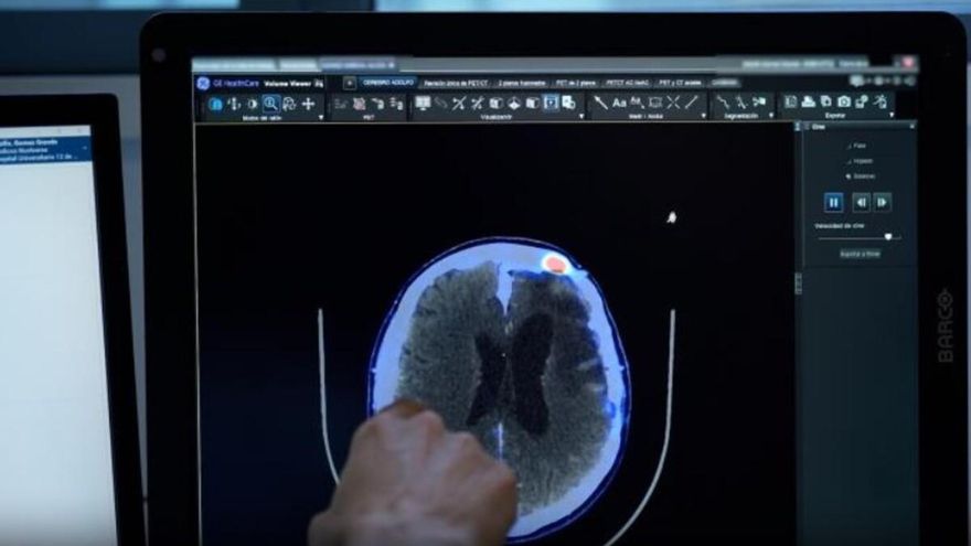 Ensayo clínico para pacientes con meningioma recurrente
