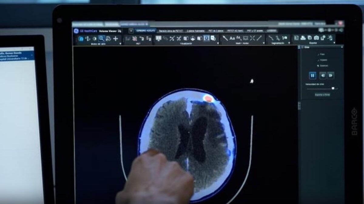 Ensayo clínico para pacientes con meningioma recurrente