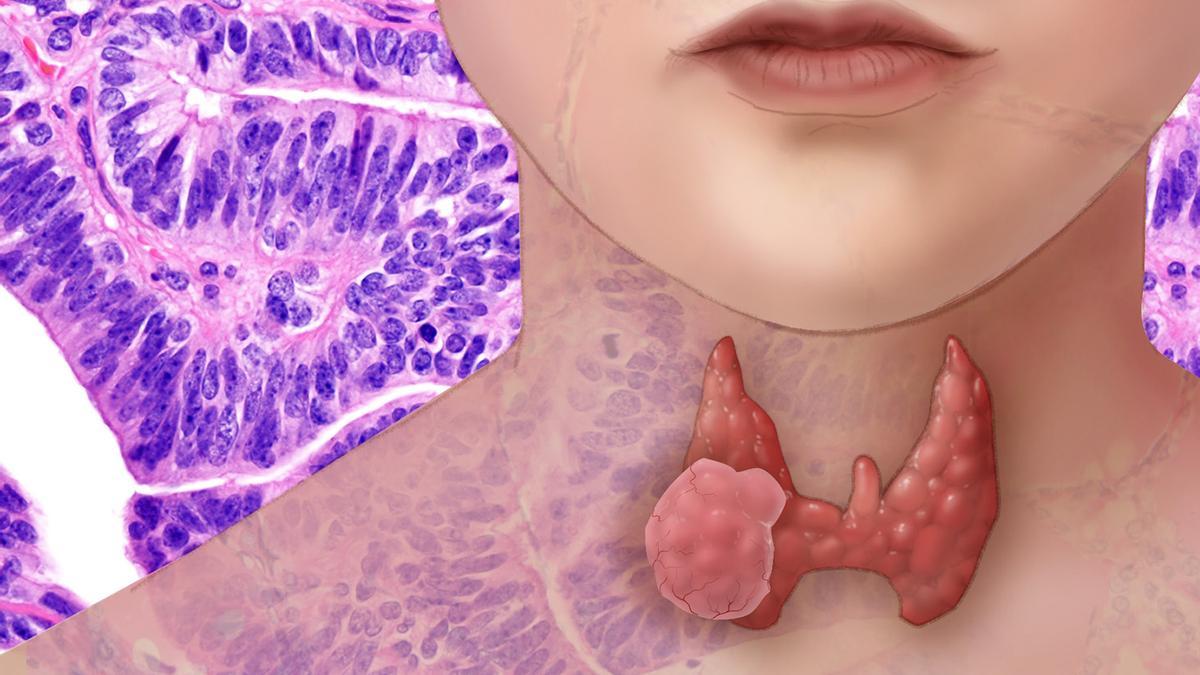El cáncer de tiroides es muy tratable con cirugía pero es el cáncer de más rápido crecimiento