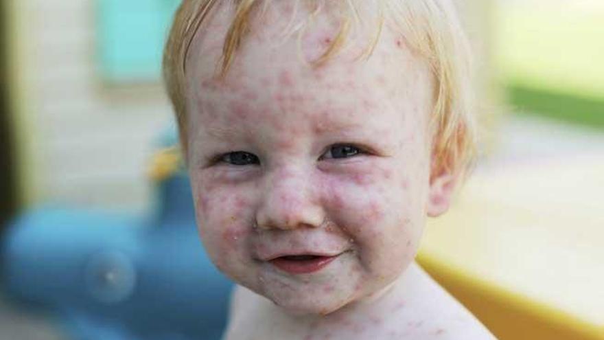 Un niño con varicela.