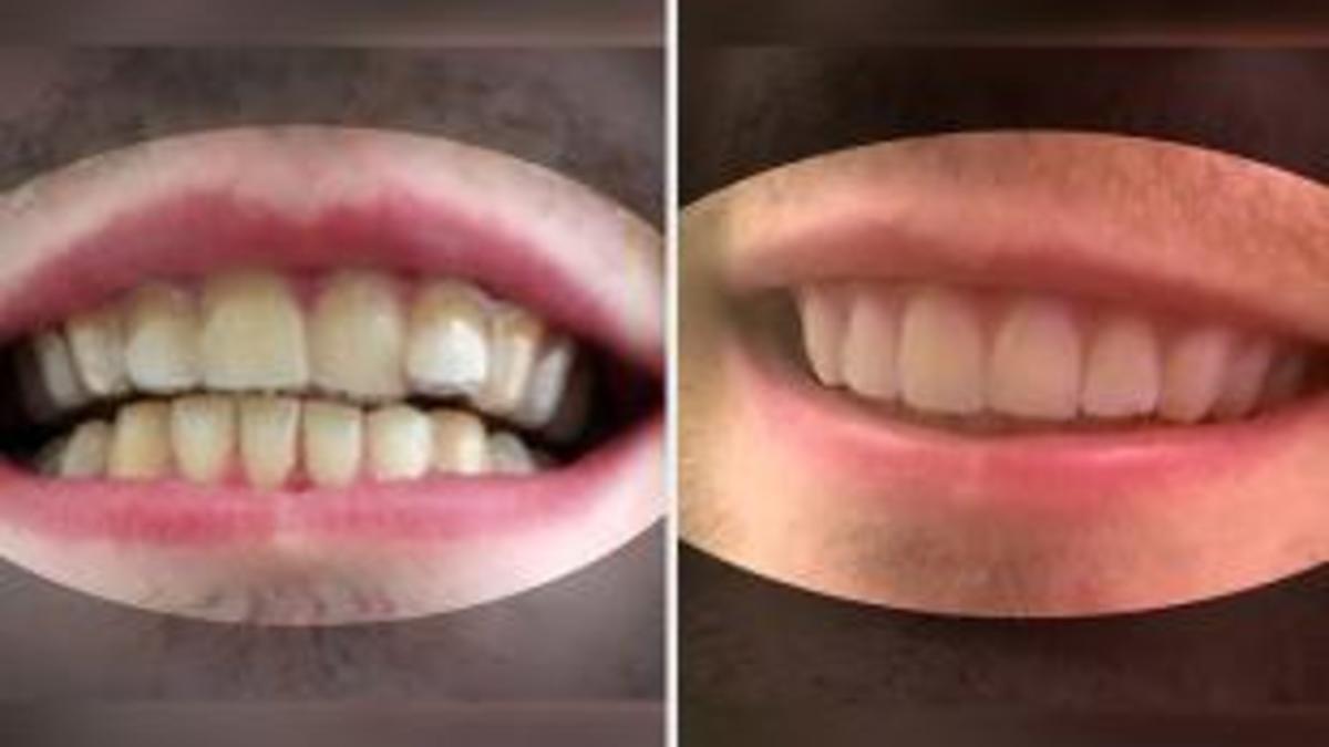 Los dientes de Amos Dudley, antes y después de su tratamiento.