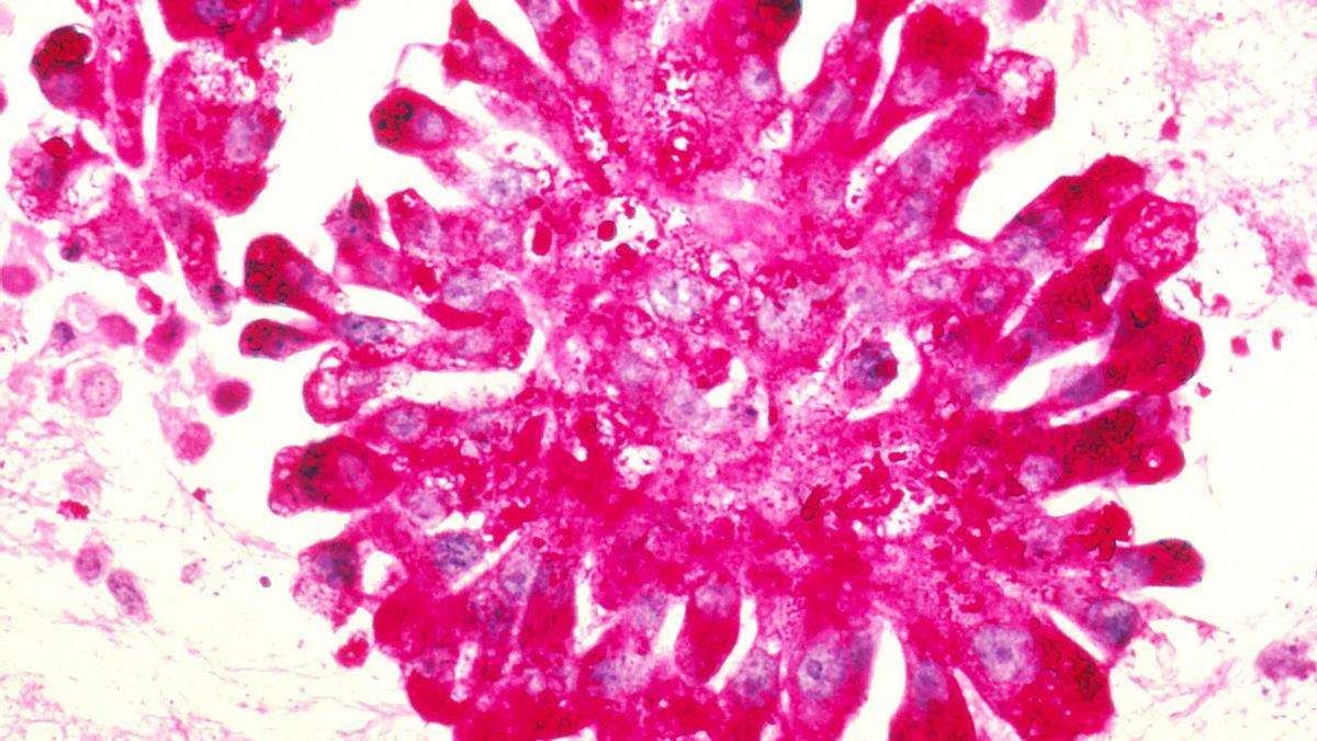 Imagen de un Sarcoma de Ewing en el Líquido Pleural