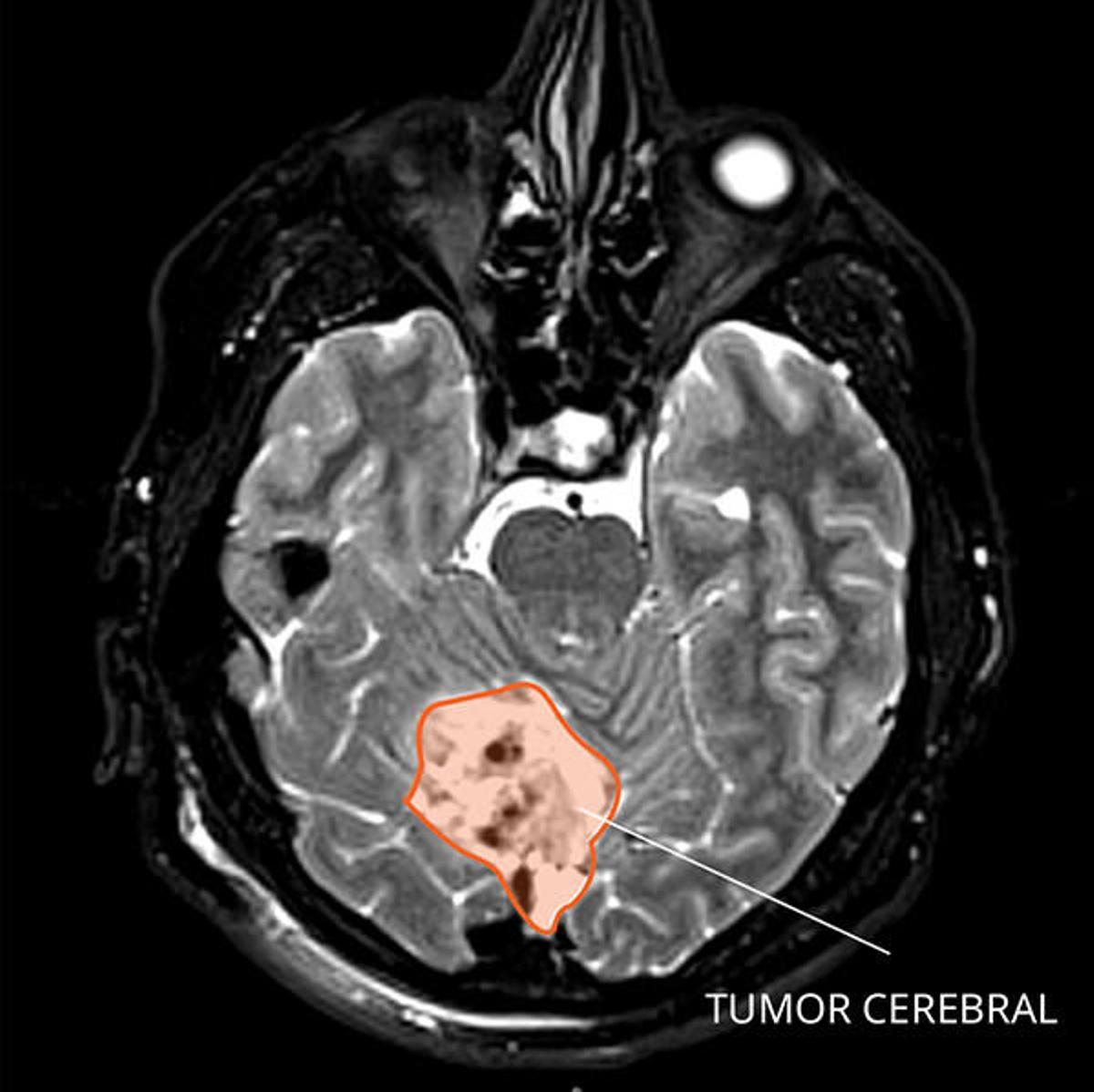 Descubren una forma de matar de hambre a los tumores cerebrales