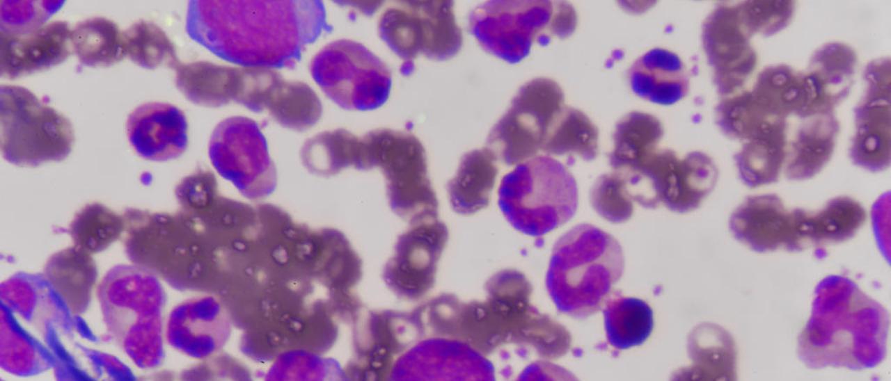 Células afectadas de leucemia.